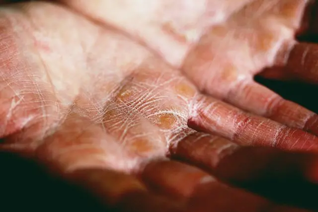 mãos ressecadas com dermatite